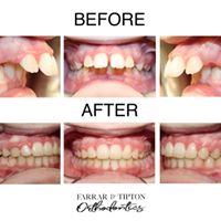 before and after teeth