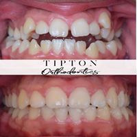 before and after teeth
