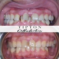 before and after teeth