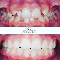 before and after